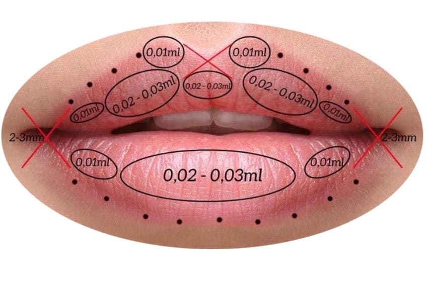 Dreamfillz Lip Shaped Molds, Pressure Practice, Hyaluron Pen Training, Needless Lip Augmentation, Training, Hyaluron Pen Lips